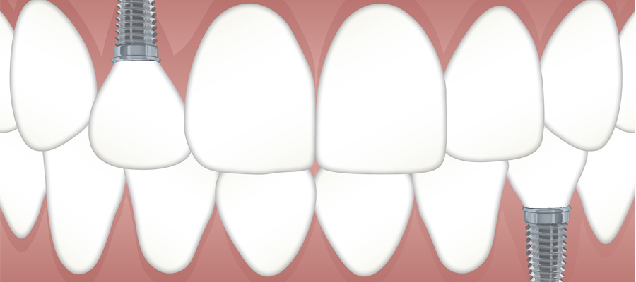 Impianti dentari: quali sono i migliori presenti in commercio?