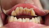 Di cosa si occupa un dentista gnatologo?