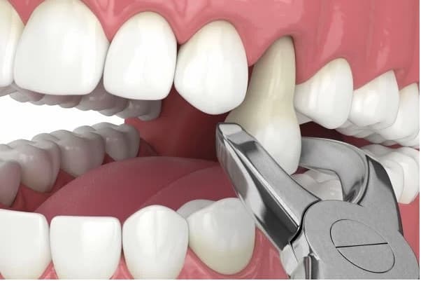chirurgia orale ed estrazione denti a Cagliari
