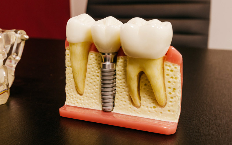 Come funziona l'implantologia dentale