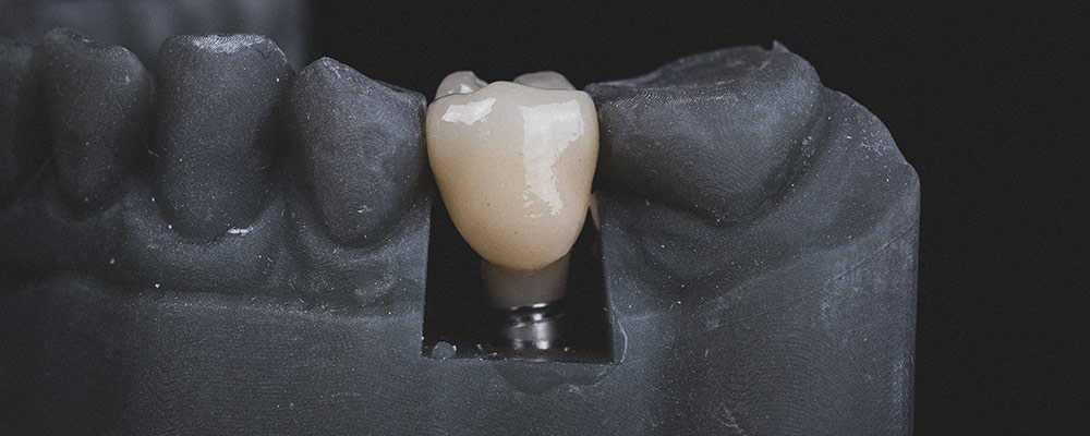 Controindicazioni per l'implantologia dentale