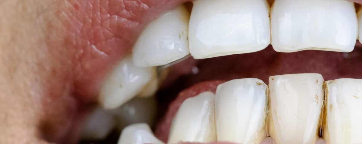 Alimenti che macchiano i denti: quali sono e come evitarlo