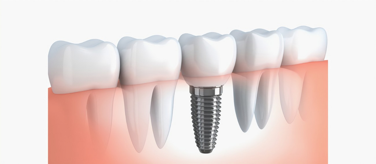 implantologia dentale a Cagliari