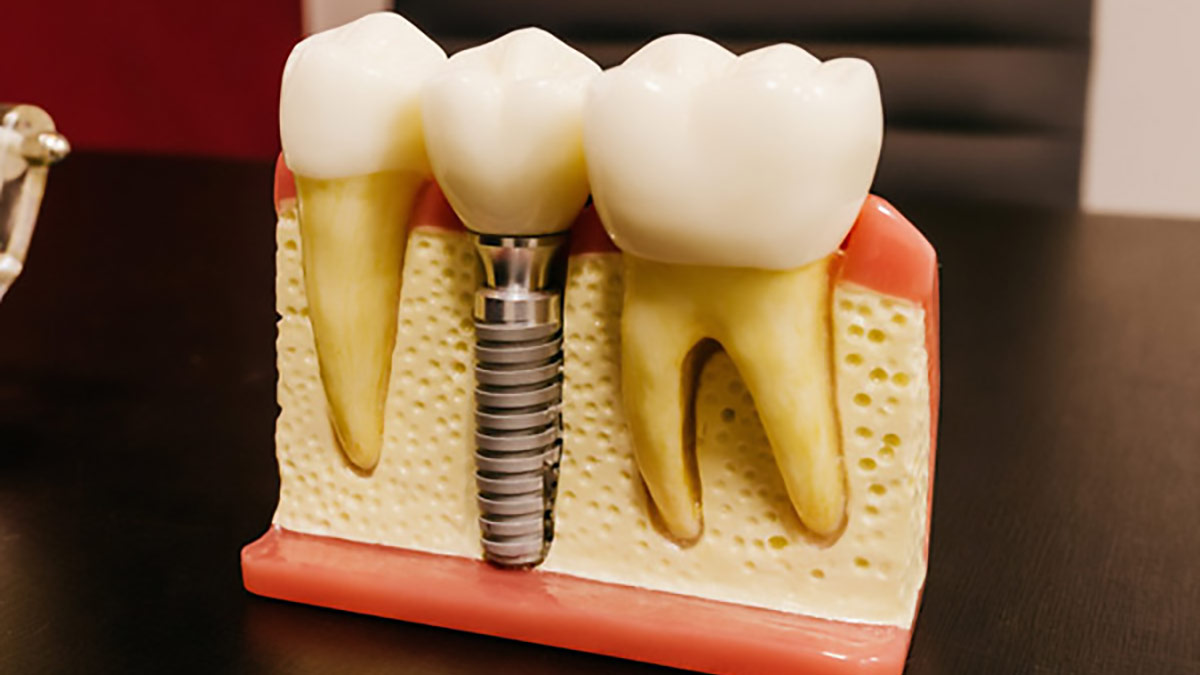 Come funziona l'implantologia dentale?