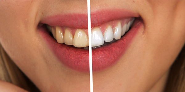 Prima e dopo - Sbiancamento dentale