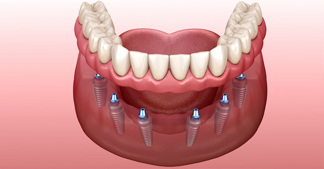 protesi dentale inferiore su impianto