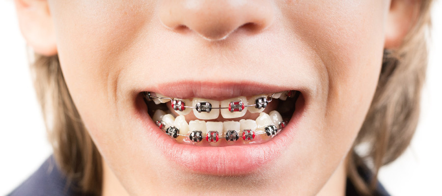 Quando si mette l'apparecchio ai denti ai bambini?