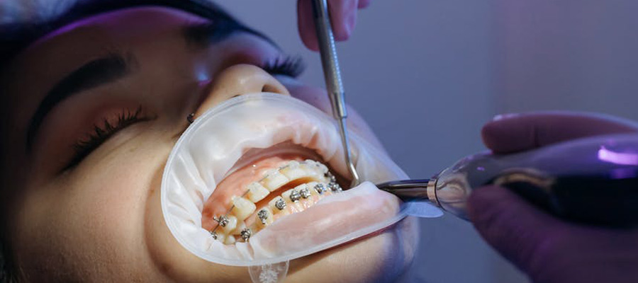 Quanto tempo bisogna tenere l'apparecchio ai denti?
